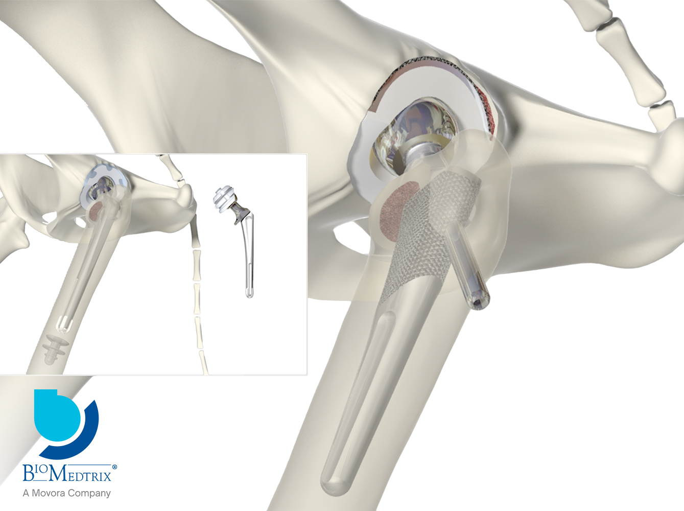 Total Hip Replacement – BioMedtrix